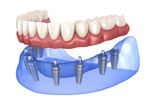 Prótesis sobre Implantes