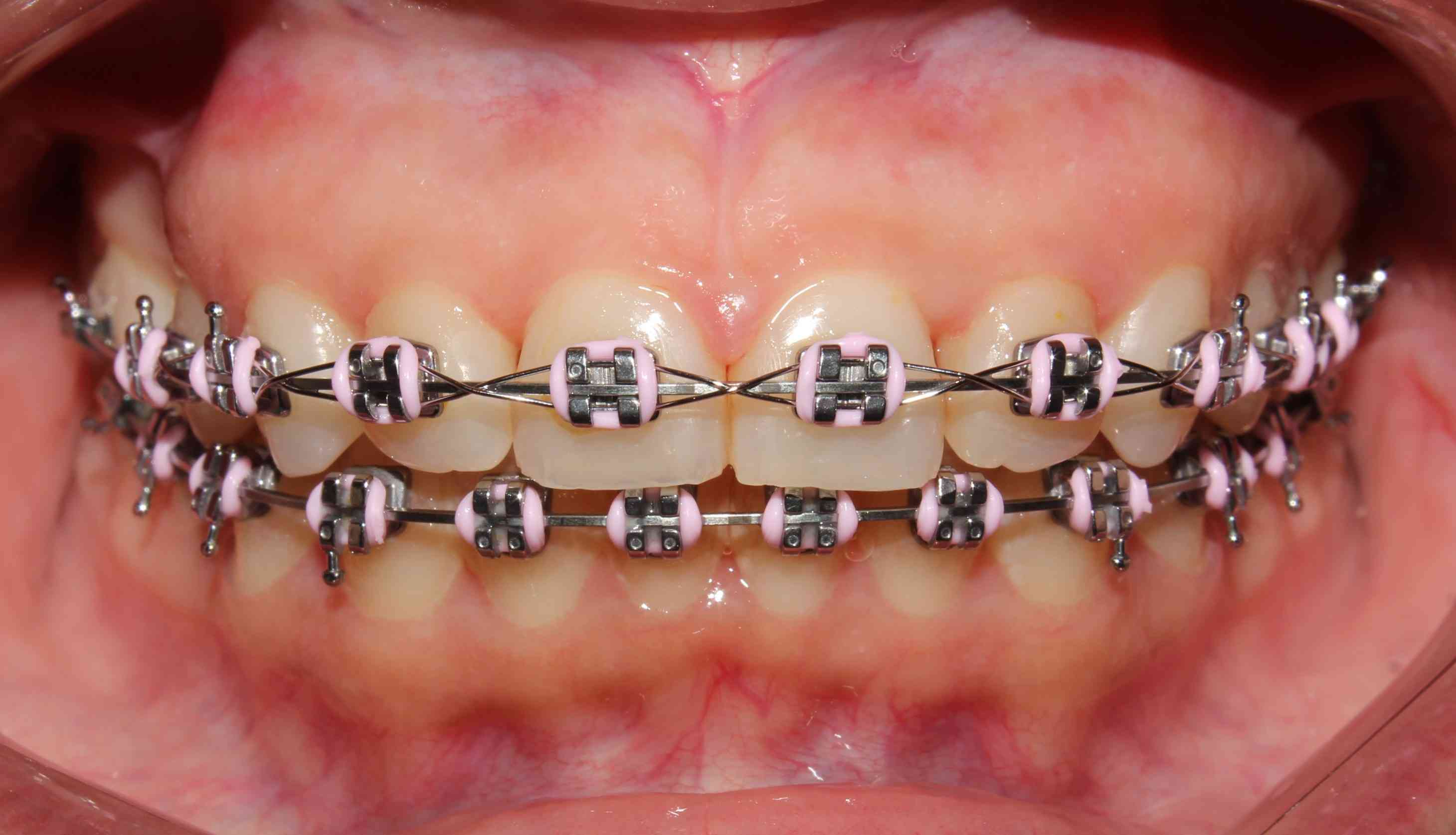 Brackets Metalicos