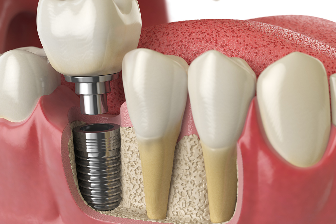 Implantes Dentales