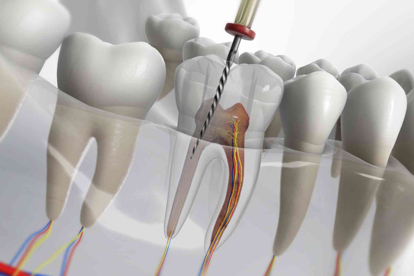 Endodoncias (Tratamientos de Conductos)